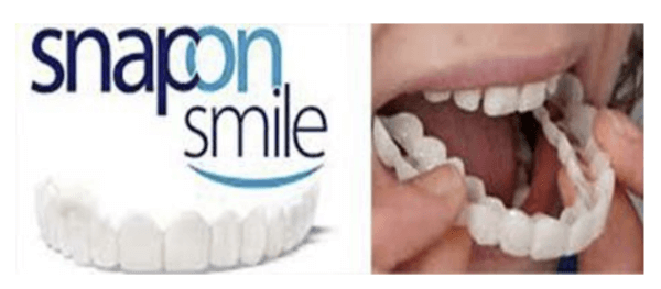 Snap-On Smile – Какво Е